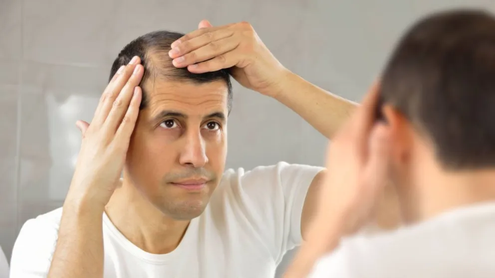 ¿Se te cae el pelo? Aseguran que el coronavirus podría ser el causante de esta problemática 