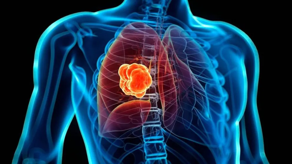 Día Internacional de la Lucha Contra el Cáncer de Pulmón: cuáles son los síntomas y cómo prevenirlo